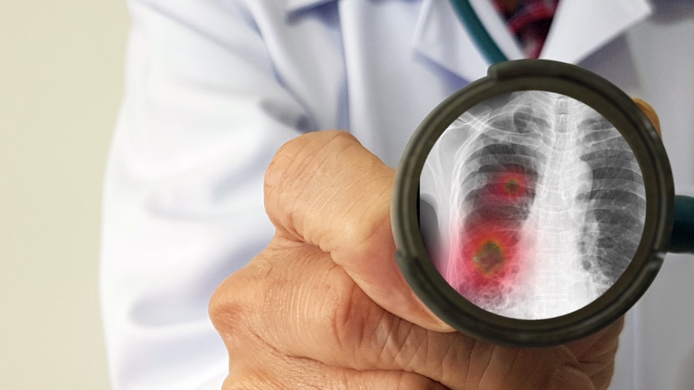 Co to jest śródmiąższowe zapalenie płuc? Jakie są objawy i przyczyny?