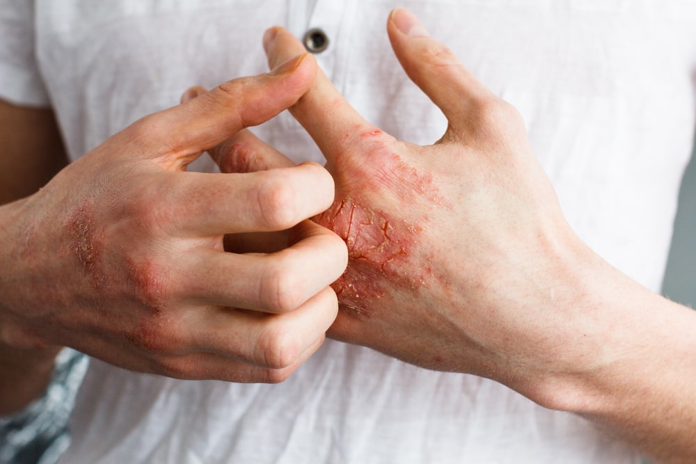 Co to jest atopowe zapalenie skóry? Jak się objawia AZS?