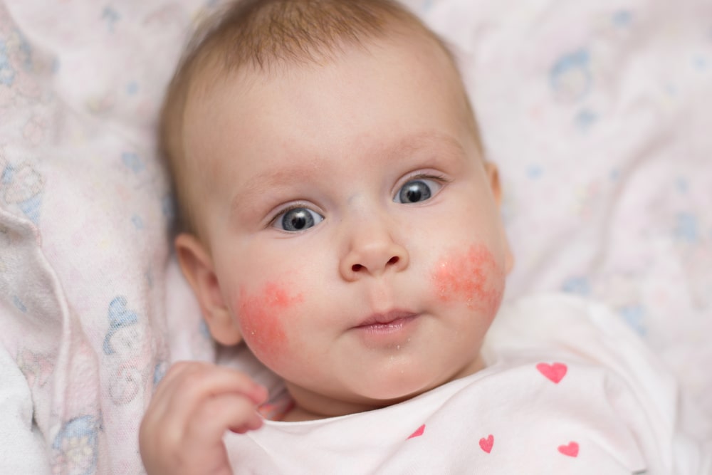 Czym jest atopowe zapalenie skóry u dzieci? Jak leczyć AZS?