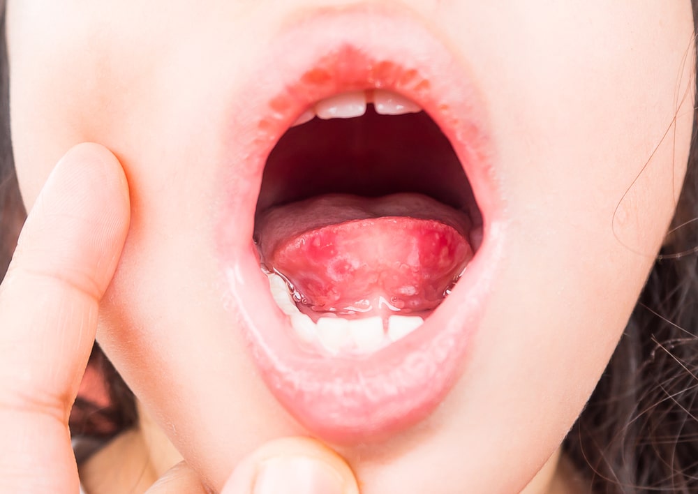 Czego objawem może być ból pod językiem? Do jakiego lekarza się zwrócić, gdy boli pod językiem?