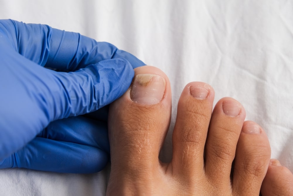 Czym jest onycholiza paznokci? Jakie są objawy onycholizy?