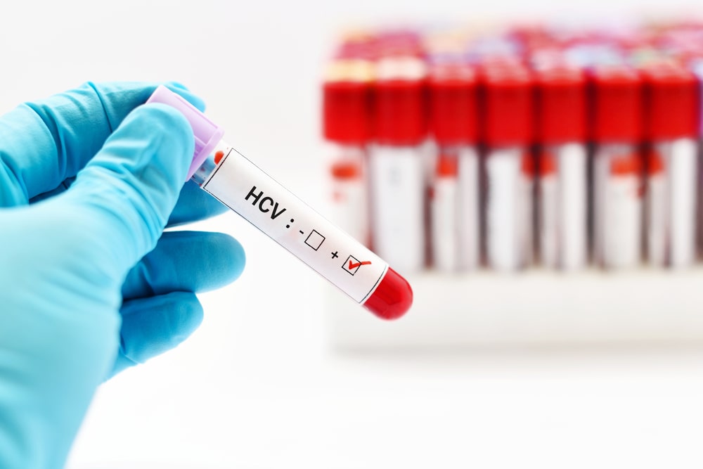 Co to jest wirus HCV? Jakie objawy ma HCV?