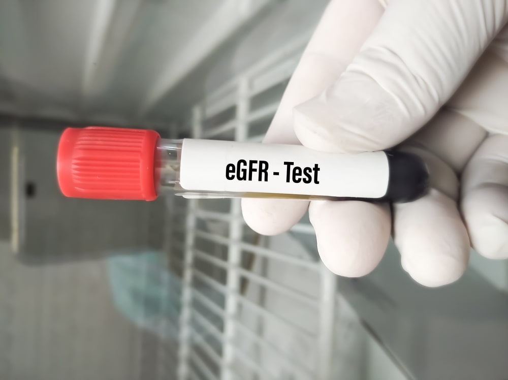 Jak oblicza się wartość EGFR? Jak interpretować wyniki badań EGFR?