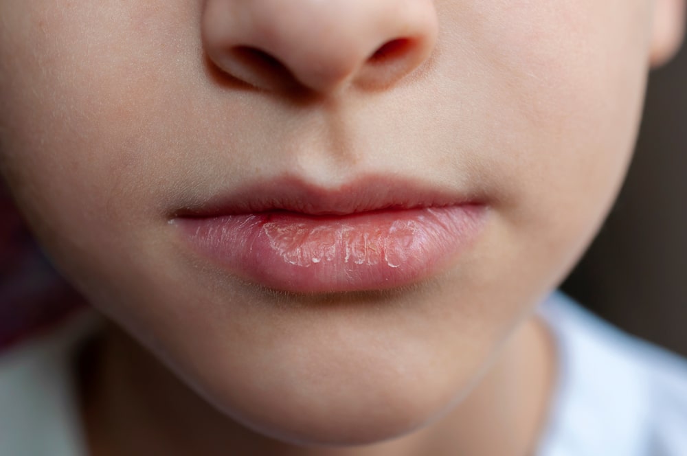 Spierzchnięte usta u dziecka – jak można je wyleczyć?