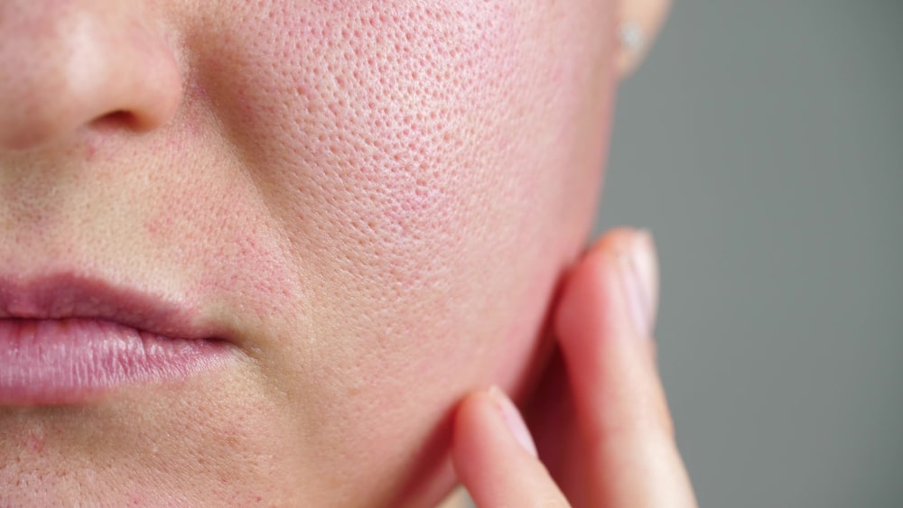 Co może wywołać wypieki na twarzy? Czy wypieki na twarzy mogą być objawem alergii?