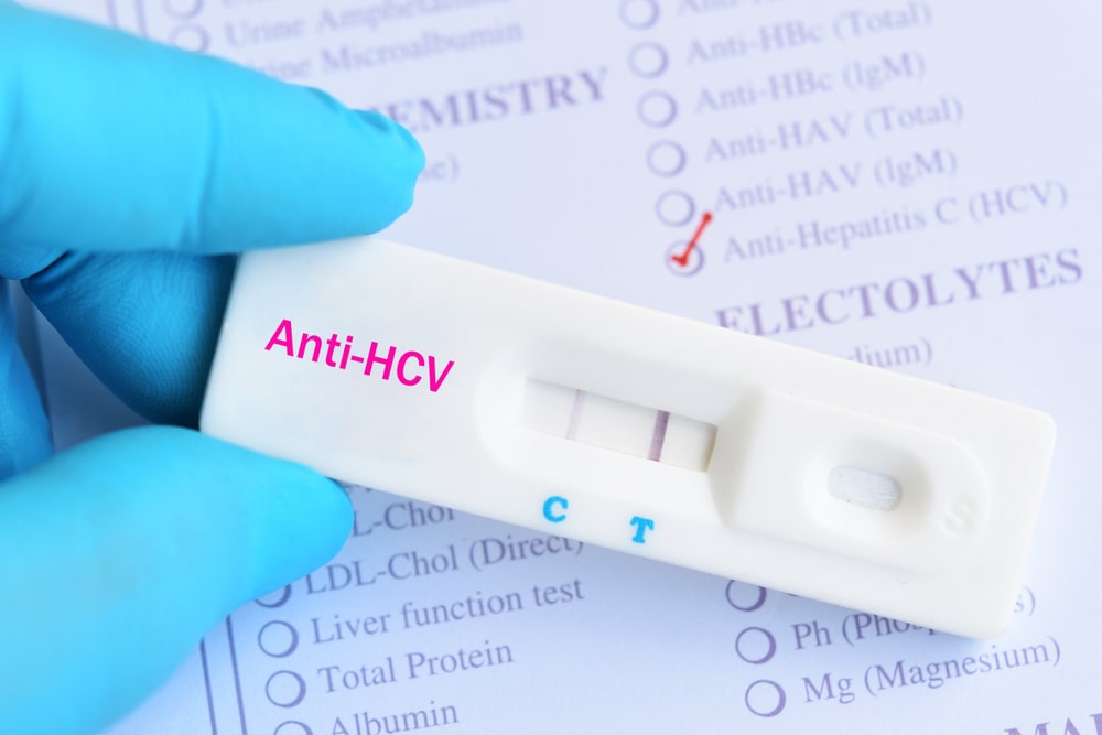 Jak wygląda badanie anty HCV?