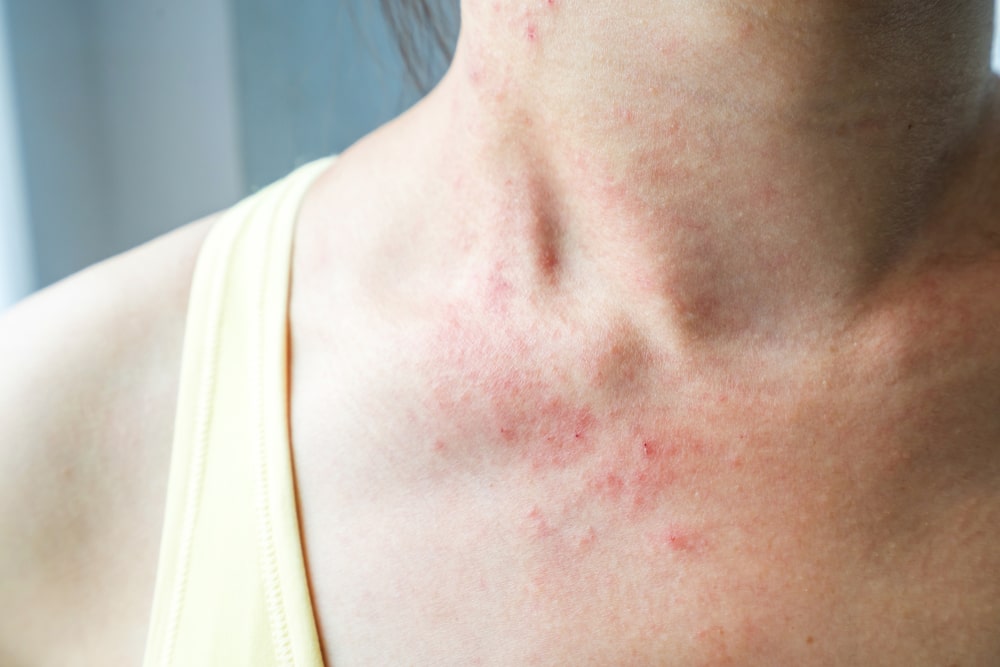 Czym jest i skąd się bierze wysypka alergiczna?